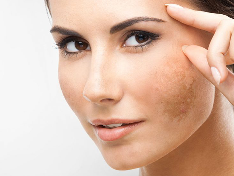 melasma-dra-juliana-franco